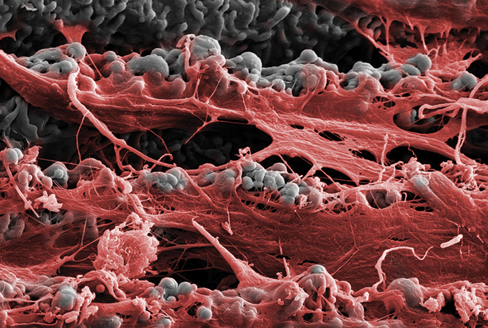 Laser-Lok microchannels